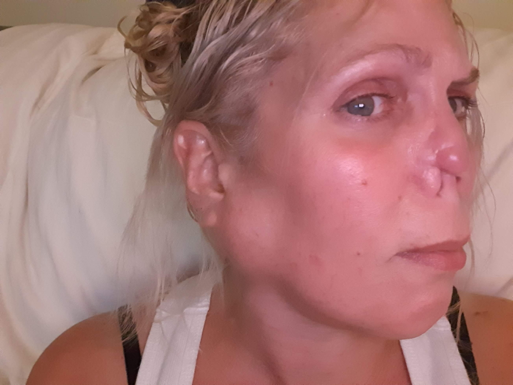 Florida: Close-up of blonde woman showing her facial scars, disfigured nose.