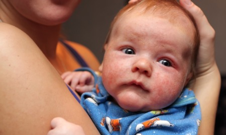 Childhood eczema research grants: baby with reddened rashes on face being held by mother