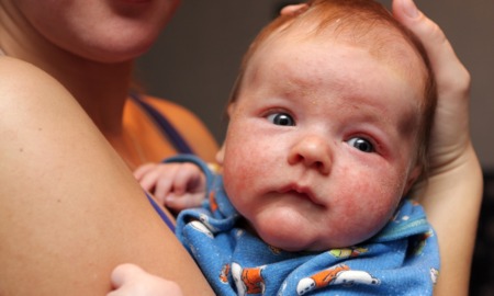 Childhood eczema research support grants: baby with eczema on face being held by mother